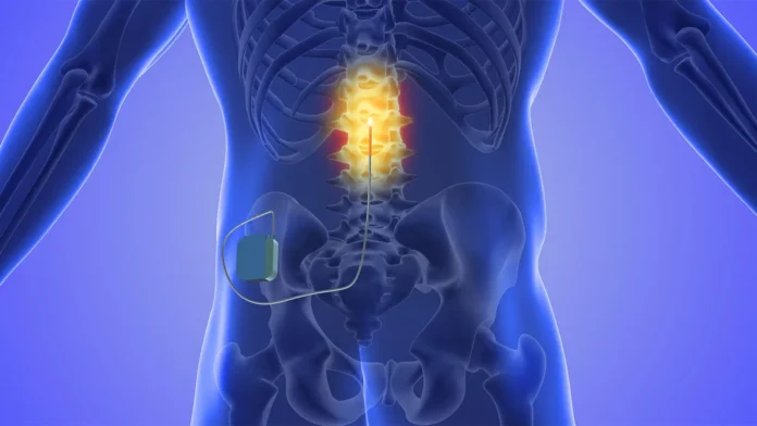 Spinal Cord Stimulation Restores Hand and Arm Mobility After Stroke A computer rendering of cervical epidural spinal cord stimulation.