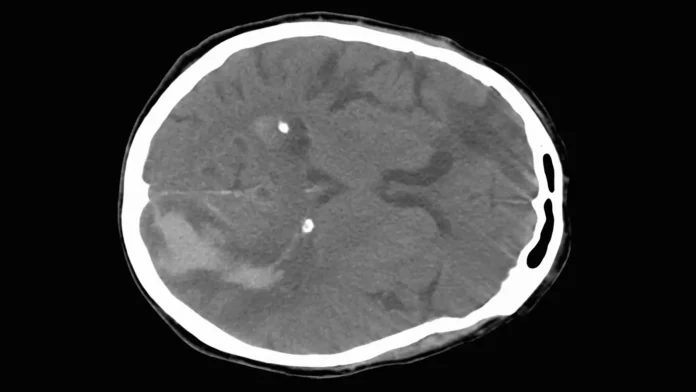 A CT scan of a brain showing a stroke.