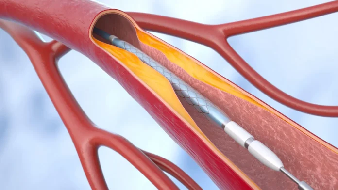 One Patient Profile Emerges as Extra-Well Suited for Extra-Long DAPT A computer rendering of stent deployment in an artery.
